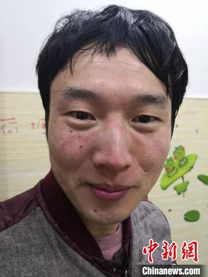 謝華寶的臉上被防護面罩勒出了紅紅的印痕。供圖