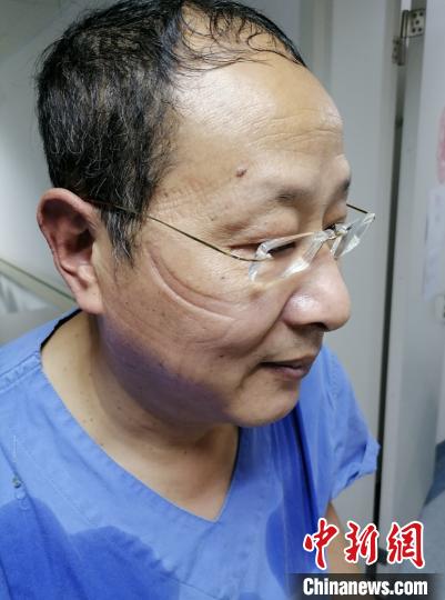 摘下防護用具的章渭方。　浙大一院 供圖 攝